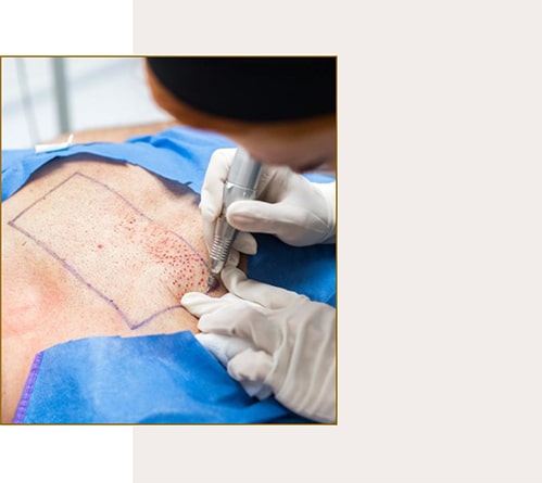 کاشت مو به روش BHT Hair Transplant کاشت مو به روش BHT Hair Transplant